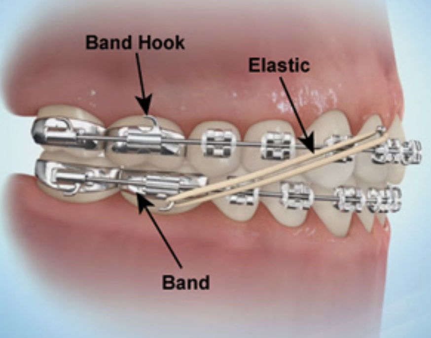 Braces Bands That Connect At Stephen Hyatt Blog