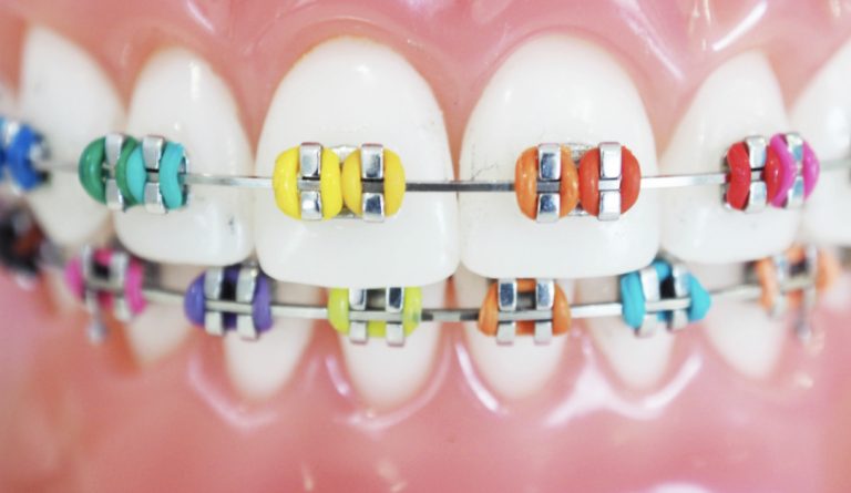 How do Braces work – Braces For U